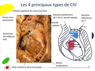 Les CIV comment mieux les dépister et identifier celles qui nécessitent une gestion particulière ? embryologie