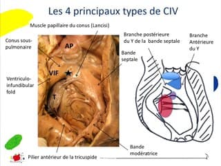 Les CIV comment mieux les dépister et identifier celles qui nécessitent une gestion particulière ? embryologie