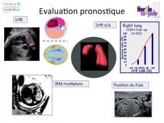 HCD Droite: Peut-on évaluer le pronostic?