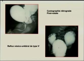 Dilatation pyélique