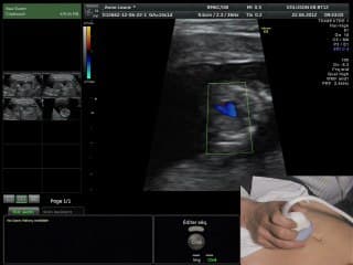 Echographie du premier trimestre : Voie abdominale live