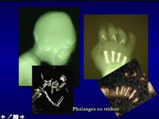 Le scanner osseux : a_ quel moment le demander ? qu'en attendre ? 3D ou scanner ?