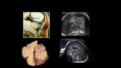 Anomalies isolées de la fosse cérébrale postérieure Sémiologie échographique (embryologie et échographie).