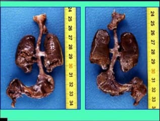 Pathologies pulmonaires : définitions - anatomopathologie