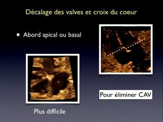 L' examen du coeur : Etude détaillée de la coupe des quatre cavités : topo