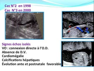 Trajet inhabituel de la V.O. : un pronostic pas toujours favorable
