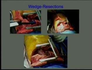 Mucoviscidose : greffes et mucoviscidose