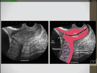 Imagerie des cicatrices utérines : Au premier trimestre de la grossesse