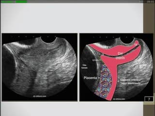 Imagerie des cicatrices utérines : Au premier trimestre de la grossesse