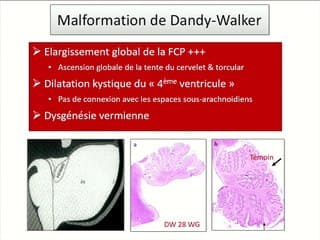 Intérêt d'un diagnostic différentiel entre kyste de la poche de Blake et malformation de Dandy Walker isolée.