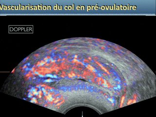 Cancérologie : et si l'échographie remplaçait l'IRM ? Cancer du col