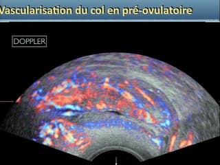 Cancérologie : et si l'échographie remplaçait l'IRM ? Cancer du col