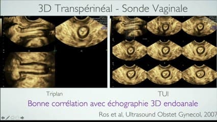 ÉCHOGRAPHIE EN SALLE DE TRAVAIL Le périnée du post-partum