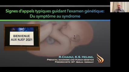 Signes d'appels typiques guidant l'examen génétique : du signe échographique au syndrome