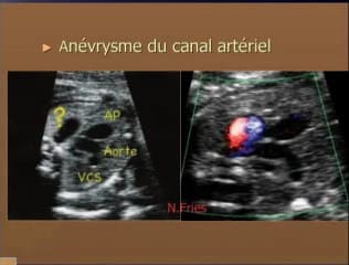 Tumeurs du médiastin : travail collectif