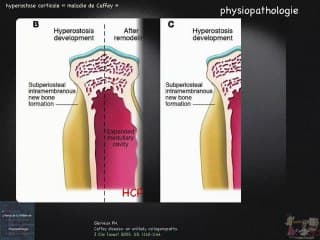 A propos d’un cas dhyperostose corticale