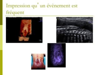 Épidémiologie des anomalies de fermeture du tube neural. De l'intér't d'un registre des malformations