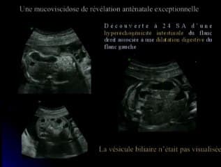 Mucoviscidose : péritonite méconiale