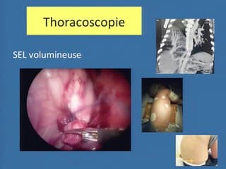 Apport de la thoracoscopie dans le traitement des séquestrations pulmonaires chez l'enfant