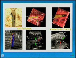 Atrésie de l’oesophage : deuxième trimestre, veine azygos ou espace aorto-carène ?