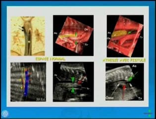 Atrésie de l’oesophage : deuxième trimestre, veine azygos ou espace aorto-carène ?