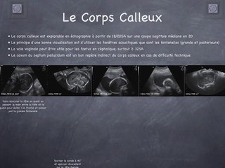 POSTER Corps Calleux
