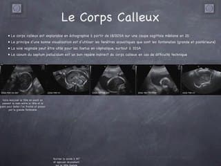 POSTER Corps Calleux