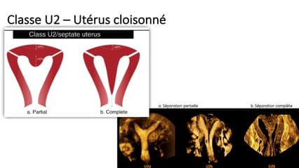 Malformations utérines congénitale ou acquises