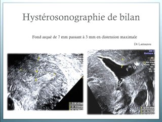 Echographie gynécologique au 1er trimestre de la grossesse: Découverte fortuite