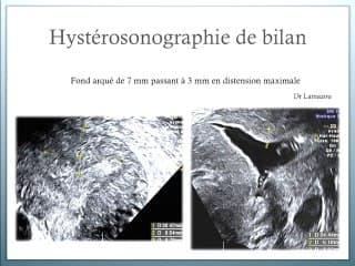 Echographie gynécologique au 1er trimestre de la grossesse: Découverte fortuite