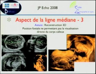 Dépistage des anomalies cérébrales