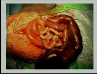 Mucoviscidose : le chirurgien face aux manifestations digestives de la mucoviscidose