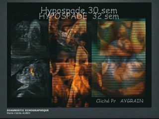 Anomalies des organes génitaux externes : Diagnostic échographique