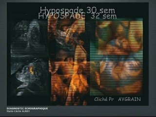 Anomalies des organes génitaux externes : Diagnostic échographique