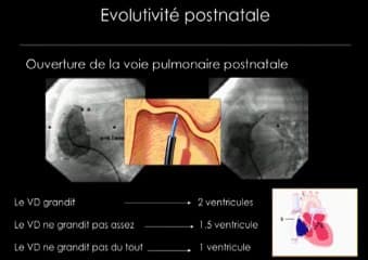 De la coarctation à l’hypoVG