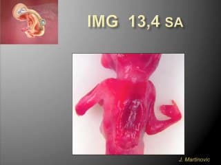 La chirurgie bariatrique : une chance pour la femme obèse, un danger pour le foetus ?