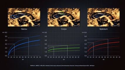 Cerveau foetal II : c’est trop gros ! Corps calleux épais