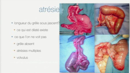 Examiner le tube digestifL’aspect échographique normal, l’examen de dépistage et les signes pathologiques. Quelles conséquences pour les collègues périnatalogistes et les collègueschirurgiens pédiatriques ?