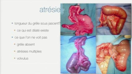 Examiner le tube digestifL’aspect échographique normal, l’examen de dépistage et les signes pathologiques. Quelles conséquences pour les collègues périnatalogistes et les collègueschirurgiens pédiatriques ?