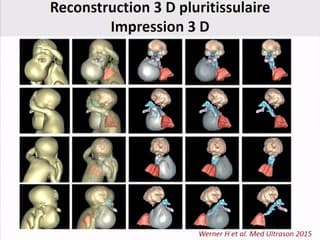 Bibliographie récente en imagerie du cou (hors nuque)