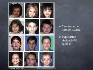 BOBS multifish Syndromes microdélétionnels