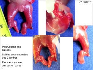 Séquence de Pierre Robin: grands cadres étiologiques à partir d'une série clinique sur 3 ans