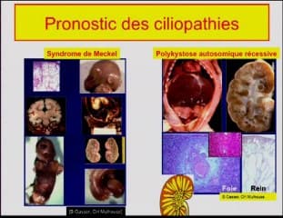 Synthèse : Quand doit-on penser aux maladies ciliaires ?