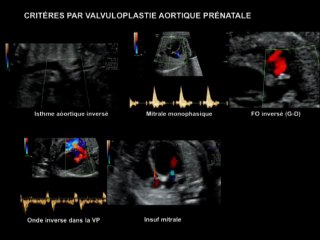Cathétérisme interventionnel : état actuel en prénatal
