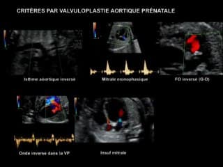 Cathétérisme interventionnel : état actuel en prénatal