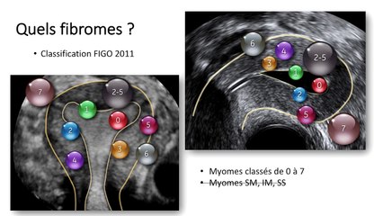Bilan de l’utérus* Vous avez dit synéchie ? › Fribromes, polypes, lesquels doivent se traiter en PMA ?