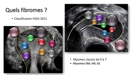 Bilan de l’utérus* Vous avez dit synéchie ? › Fribromes, polypes, lesquels doivent se traiter en PMA ?