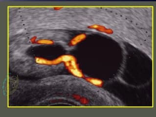 SLO (Smith Lemli Opitz), holoproencéphalie, fistule de l'ouraque