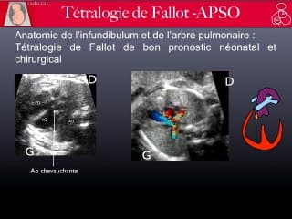 Malformations cardiaques : De la tétralogie de Fallot à l'atrésie pulmonaire : un « spectre » à haut risque syndromique :