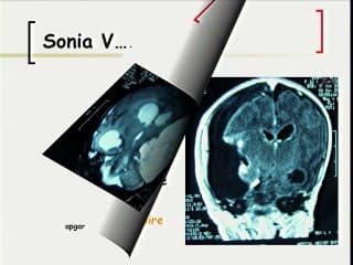 5 Pathologies du cerveau foetal hémorragies cérébrales